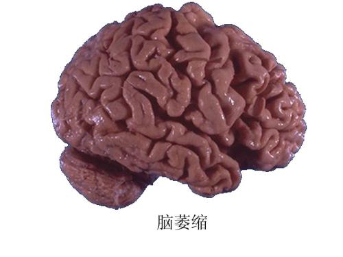 患上脑萎缩还能活多少年