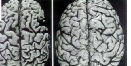 为什么年轻人更易得脑萎缩呢?